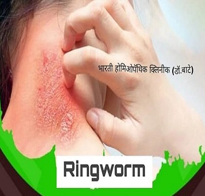 Ringworm Skin Diseases