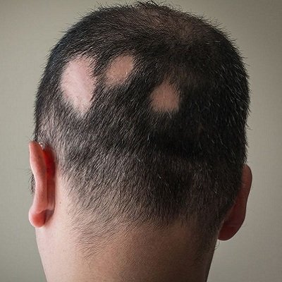 केसांचे रोग