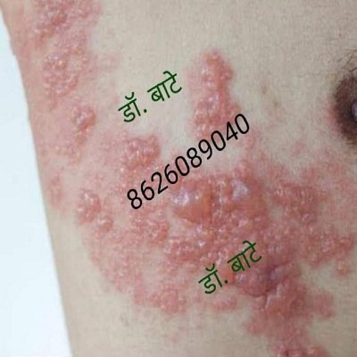 त्वचाविकार